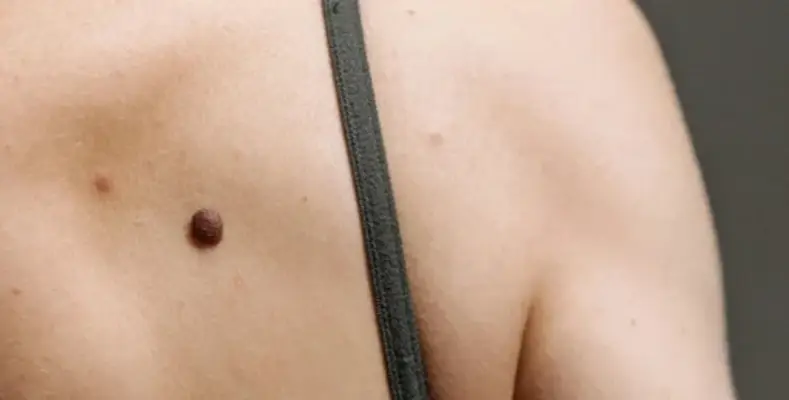 Know the different types of moles