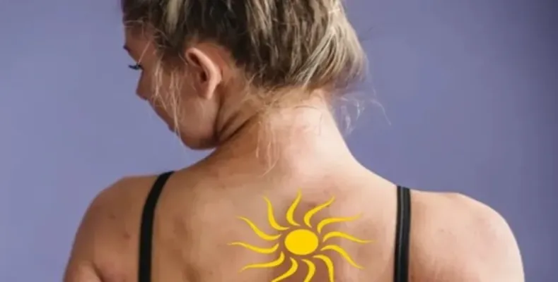 How to take care of skin in summer