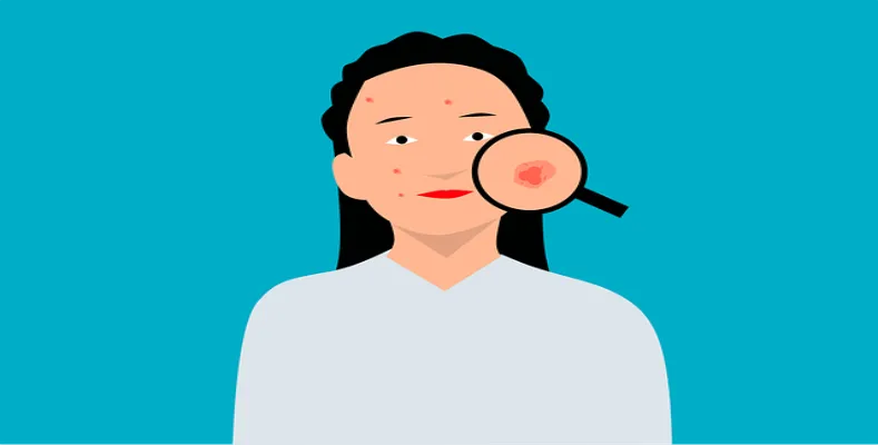 The best ways to deal with Acne